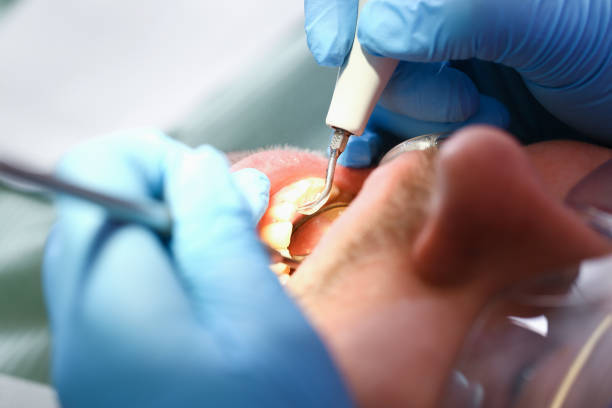 Best Knocked-Out Tooth (Avulsed Tooth) Treatment in San Rlos, CA